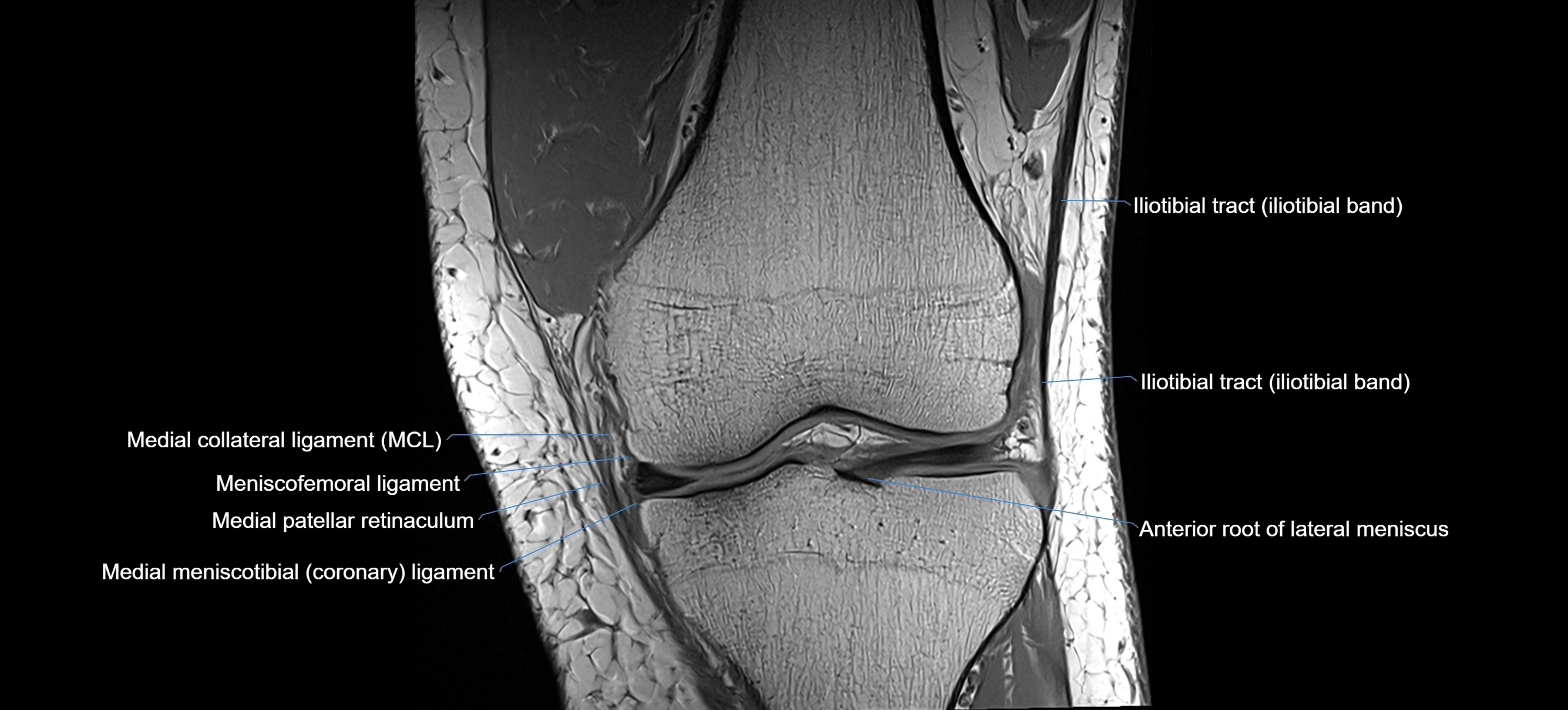 MRI coronal  ligaments cross sectional anatomy 3T  radiology  image-img-04001-00017.webp